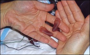Amillia, el bebé más prematuro del mundo logró sobrevivir. Tenía al nacer 22 semanas de gestación.