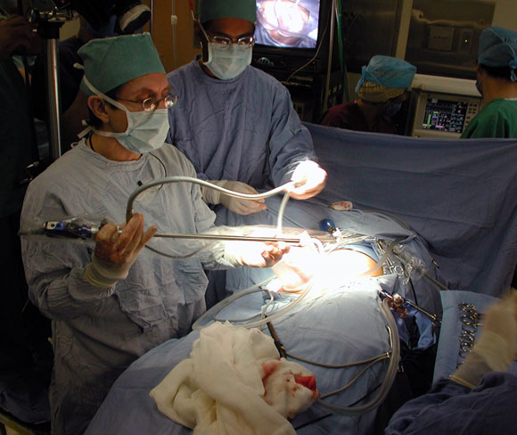 Intervanción quirúrgica para la donación de un riñón