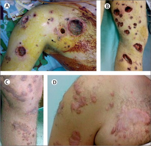 Quemadura por fósforo blanco  Lesiones múltiples con intensa destrucción subcutánea y necrosis en hombro derecho (A) y pierna izquierda (B). Después de 16 meses de seguimiento (C, D)
