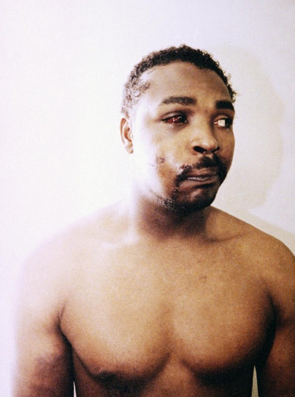 Rodney King en marzo de 1991 después de la golpiza. Foto: AP