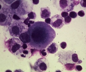 cancer-cells1