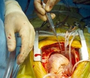 Paciente transplantado en Francia cumple treinta días con corazón artificial