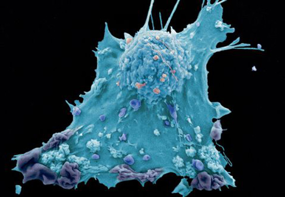 Imagen de una célula cancerosa de mama.
