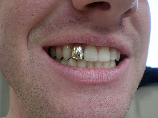 dientes de oro